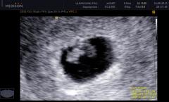 На якому терміні вагітності і при якому ХГЧ видно ембріон: достовірність дослідження на перших тижнях В які терміни УЗД бачать ембріон